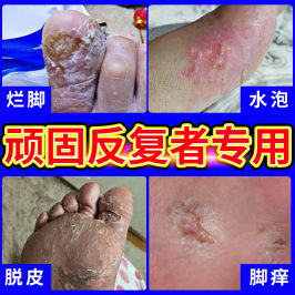 脚气药脚痒水泡喷剂止痒脱皮杀菌药包水泡型泡脚足光粉日本抗真菌